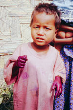 A child treated for infected scabies bites